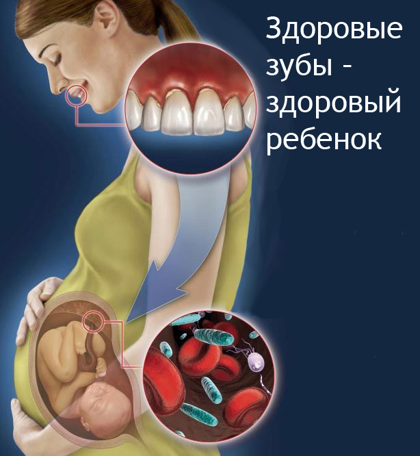 Лечение зубов при беременности, что нужно знать.