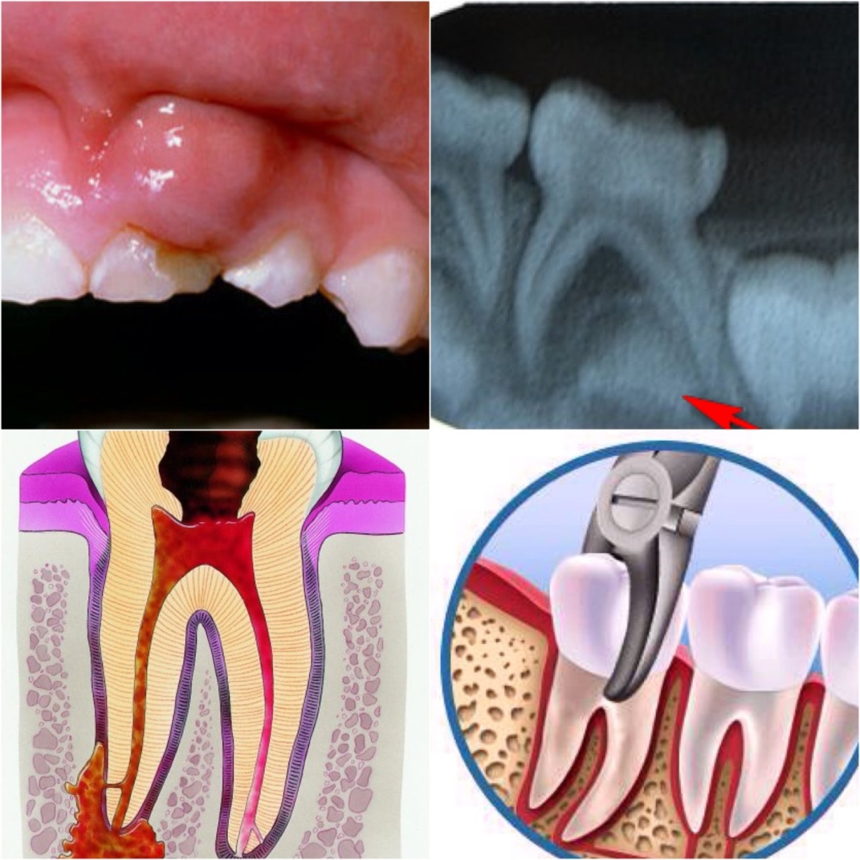 Лечение пульпита и периодонтита молочных зубов