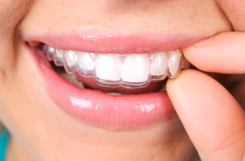 Инвизилайн ортодонтическое лечение зубов